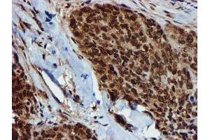 Immunohistochemical staining of paraffin-embedded Adenocarcinoma of Human breast tissue using anti-GSTT2 mouse monoclonal antibody.