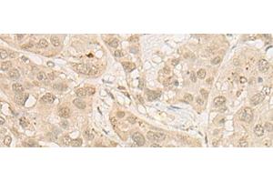 Immunohistochemistry of paraffin-embedded Human esophagus cancer tissue using RSU1 Polyclonal Antibody at dilution of 1:30(x200) (RSU1 antibody)