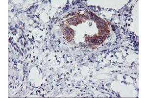 Immunohistochemical staining of paraffin-embedded Carcinoma of Human pancreas tissue using anti-NMT2 mouse monoclonal antibody.