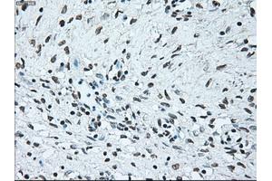 Immunohistochemical staining of paraffin-embedded Adenocarcinoma of colon tissue using anti-BRAFmouse monoclonal antibody. (BRAF antibody)