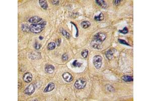 IHC analysis of FFPE human hepatocarcinoma tissue stained with Tuberin antibody