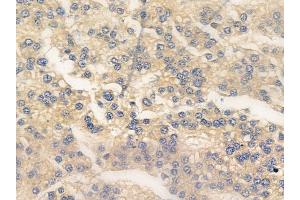 ABIN6255950 and ABIN6267275 at 1/100 staining human hepatocellular carcinoma by IHC-P.