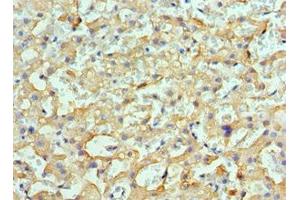 Immunohistochemistry of paraffin-embedded human liver cancer using ABIN7154901 at dilution of 1:100 (HSPH1 antibody  (AA 659-858))