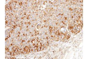 IHC-P Image Immunohistochemical analysis of paraffin-embedded SW480 xenograft, using BCKDK, antibody at 1:100 dilution. (BCKDK antibody)