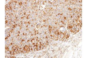 IHC-P Image Immunohistochemical analysis of paraffin-embedded SW480 xenograft, using BCKDK, antibody at 1:100 dilution.