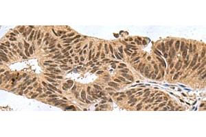Immunohistochemistry of paraffin-embedded Human colorectal cancer tissue using FBXO32 Polyclonal Antibody at dilution of 1:60(x200) (FBXO32 antibody)