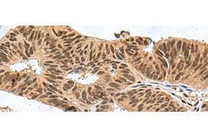 Immunohistochemistry of paraffin-embedded Human colorectal cancer tissue using FBXO32 Polyclonal Antibody at dilution of 1:60(x200)