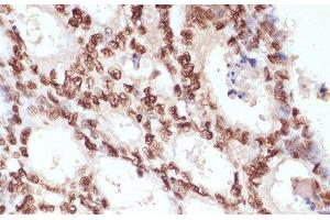 Immunohistochemistry of paraffin-embedded Human colon carcinoma using Phospho-β-catenin(S33/S37/T41) Polyclonal Antibody at dilution of 1:100 (40x lens). (beta Catenin antibody  (pSer33, pSer37, pThr41))