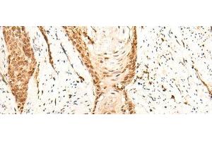 Immunohistochemistry of paraffin-embedded Human esophagus cancer tissue using EMSY Polyclonal Antibody at dilution of 1:25(x200) (EMSY antibody)