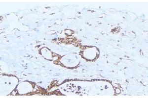 ABIN6275413 at 1/100 staining Human lung cancer tissue by IHC-P. (PPM1K antibody  (Internal Region))