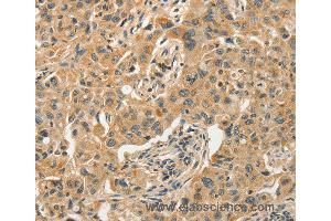 Immunohistochemistry of Human esophagus cancer using SLC11A2 Polyclonal Antibody at dilution of 1:50