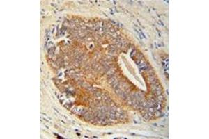 Immunohistochemistry analysis in formalin fixed and paraffin embedded human prostate carcinoma reacted with GAGE7 Antibody (C-term) followed by peroxidase conjugation of the secondary antibody and DAB staining. (G Antigen 7 antibody  (C-Term))