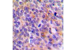 Immunohistochemical analysis of TOLLIP staining in human breast cancer formalin fixed paraffin embedded tissue section. (TOLLIP antibody  (Center))