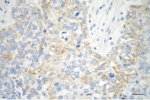Immunohistochemistry was performed on paraffin-embedded human breast carcinoma using PA2G4 antibody (ABIN7799917), 1:200). (Recombinant PA2G4 antibody)