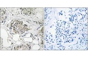 Immunohistochemistry analysis of paraffin-embedded human breast carcinoma tissue, using USP13 Antibody. (USP13 antibody  (AA 811-860))