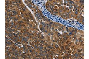 The image on the left is immunohistochemistry of paraffin-embedded Human ovarian cancer tissue using ABIN7129016(COX6B2 Antibody) at dilution 1/50, on the right is treated with fusion protein. (COX6B2 antibody)