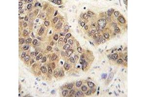IHC analysis of FFPE human hepatocarcinoma tissue stained with SUMO4 antibody (SUMO4 antibody  (Wild Type))