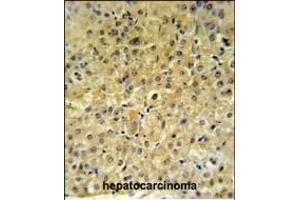 INSC Antibody (Center) (ABIN653657 and ABIN2842997) IHC analysis in formalin fixed and paraffin embedded hepatocarcinoma followed by peroxidase conjugation of the secondary antibody and DAB staining. (INSC antibody  (AA 410-437))