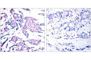 Immunohistochemistry analysis of paraffin-embedded human breast carcinoma, using c-Jun (Phospho-Thr93) Antibody.