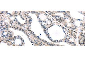 Immunohistochemistry of paraffin-embedded Human thyroid cancer tissue using KDM5C Polyclonal Antibody at dilution 1:45 (KDM5C antibody)