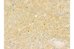 ABIN6260416 and ABIN6279231 at 1/100 staining human hepatocellular carcinoma by IHC-P. (CALML6 antibody)