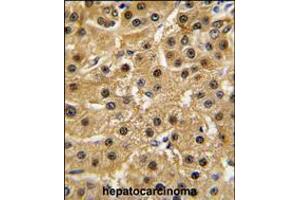 Formalin-fixed and paraffin-embedded human hepatocarcinoma tissue reacted with ABL1 antibody , which was peroxidase-conjugated to the secondary antibody, followed by DAB staining.
