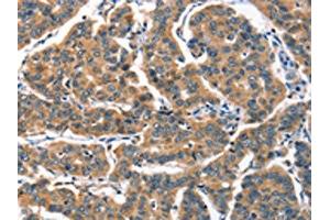 The image on the left is immunohistochemistry of paraffin-embedded Human breast cancer tissue using ABIN7189781(ALOX15 Antibody) at dilution 1/60, on the right is treated with synthetic peptide.