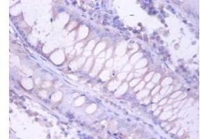 Immunohistochemistry of paraffin-embedded human colorectal carcinoma using PSMB4 antibody at dilution of 1:100. (PSMB4 antibody  (FITC))