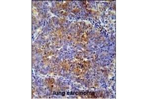 MCAF2 Antibody (Center) (ABIN654466 and ABIN2844199) immunohistochemistry analysis in formalin fixed and paraffin embedded human lung carcinoma followed by peroxidase conjugation of the secondary antibody and DAB staining. (ATF7IP2 antibody  (AA 318-347))