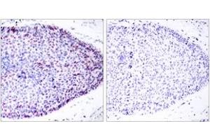 Immunohistochemistry analysis of paraffin-embedded human breast carcinoma tissue, using ATF2 (Ab-62 or 44) Antibody.