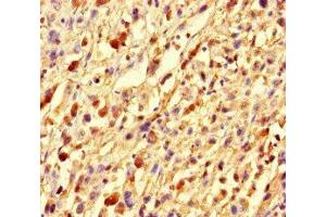 Immunohistochemistry of paraffin-embedded human melanoma using ABIN7153773 at dilution of 1:100 (GMIP antibody  (AA 719-858))