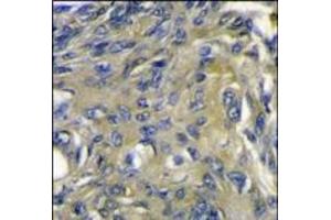 Formalin-fixed and paraffin-embedded human lung carcinoma reacted with VEGF4 Antibody (C-term), which was peroxidase-conjugated to the secondary antibody, followed by DAB staining. (VEGFD antibody  (C-Term))