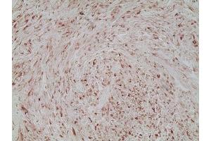 Immunohistochemistry analysis of human melanoma skin tissue using Melanoma marker (human) mAb (HMB45), (ABIN7211713) at a dilution of 1:20. (Melanoma Marker antibody)