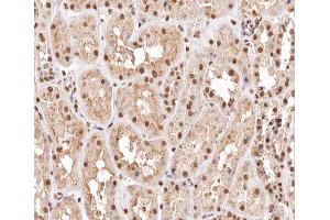 ABIN6267454 at 1/200 staining human kidney carcinoma tissue sections by IHC-P. (MKP-1/2 antibody  (pSer296, pSer318))