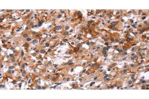 Immunohistochemistry of paraffin-embedded Human thyroid cancer using Glucagon Receptor Polyclonal Antibody at dilution of 1:40 (Glucagon Receptor antibody)