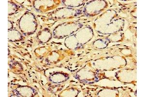 Immunohistochemistry of paraffin-embedded human gastric cancer using ABIN7156344 at dilution of 1:100
