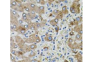 Immunohistochemistry of paraffin-embedded Human liver damage using TGFA Polyclonal Antibody (TGFA antibody)