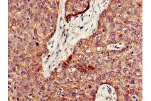 Immunohistochemistry of paraffin-embedded human ovarian cancer using ABIN7162531 at dilution of 1:100 (PPT1 antibody  (AA 100-258))