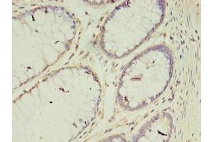 Immunohistochemistry of paraffin-embedded human colon cancer using ABIN7175400 at dilution of 1:100 (Vasohibin 2 antibody  (AA 1-156))