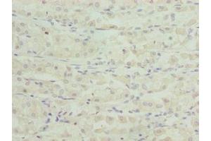 Immunohistochemistry of paraffin-embedded human gastric cancer using ABIN7171874 at dilution of 1:100 (TSPAN33 antibody  (AA 118-235))