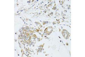 Immunohistochemistry of paraffin-embedded human gastric cancer using MAD2L2 antibody (ABIN6003593) at dilution of 1/100 (40x lens). (MAD2L2 antibody)