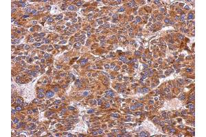 IHC-P Image Immunohistochemical analysis of paraffin-embedded human hepatoma, using Integrin alpha 9, antibody at 1:500 dilution. (ITGA9 antibody  (N-Term))