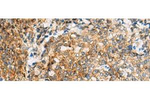Immunohistochemistry of paraffin-embedded Human cervical cancer tissue using TUFT1 Polyclonal Antibody at dilution of 1:120(x200) (TUFT1 antibody)