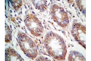 Human colon cancer tissue was stained by Rabbit Anti-CCK (26-33)  (Human,Rat) Antibody (Cholecystokinin antibody  (non-sulfated))