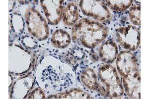 Immunohistochemical staining of paraffin-embedded Adenocarcinoma of Human endometrium tissue using anti-GAS7 mouse monoclonal antibody. (GAS7 antibody)
