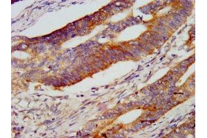 IHC image of ABIN7151176 diluted at 1:800 and staining in paraffin-embedded human colon cancer performed on a Leica BondTM system.