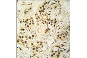 Formalin-fixed and paraffin-embedded human breast carcinoma tissue reacted with CDK1 Antibody, which was peroxidase-conjugated to the secondary antibody, followed by DAB staining.