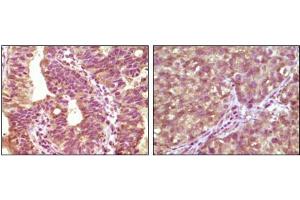 Immunohistochemical analysis of paraffin-embedded human bladder carcinoma tissue(left) and lung carcinoma tissue (right) showing cytoplasmic localization using BRAF mouse mAb with DAB staining.