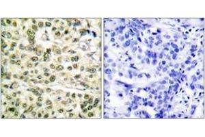 Immunohistochemistry analysis of paraffin-embedded human breast carcinoma tissue, using PCNA Antibody.