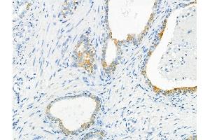 ABIN6262787 and ABIN6266575 at 1/100 staining human ovarian cancer by IHC-P. (Cytokeratin 7 antibody  (C-Term))